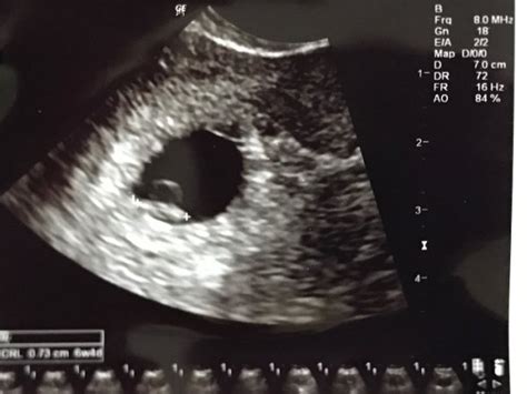 At 8 weeks, a fetal heartbeat should be visible on an ultrasound. . Can an ultrasound be wrong about no heartbeat at 10 weeks